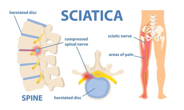 Sciatica Treatment