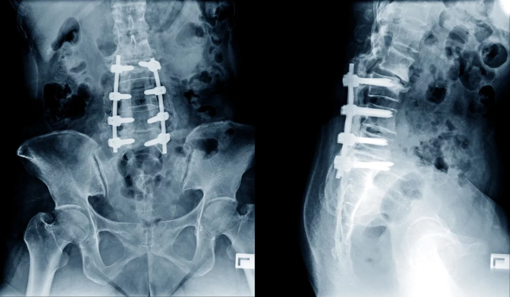 Discover the Degenerative Disc Disease Symptoms and Treatments That You Can Use Today