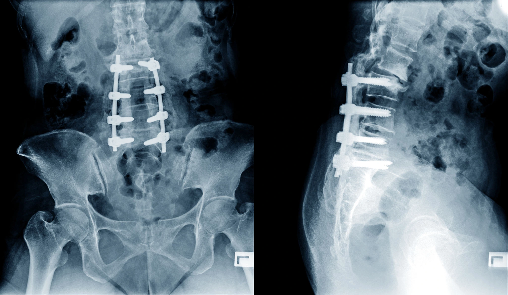 Discover-the-Degenerative-Disc-Disease-Symptoms-and-Treatments-That-You-Can-Use-Today