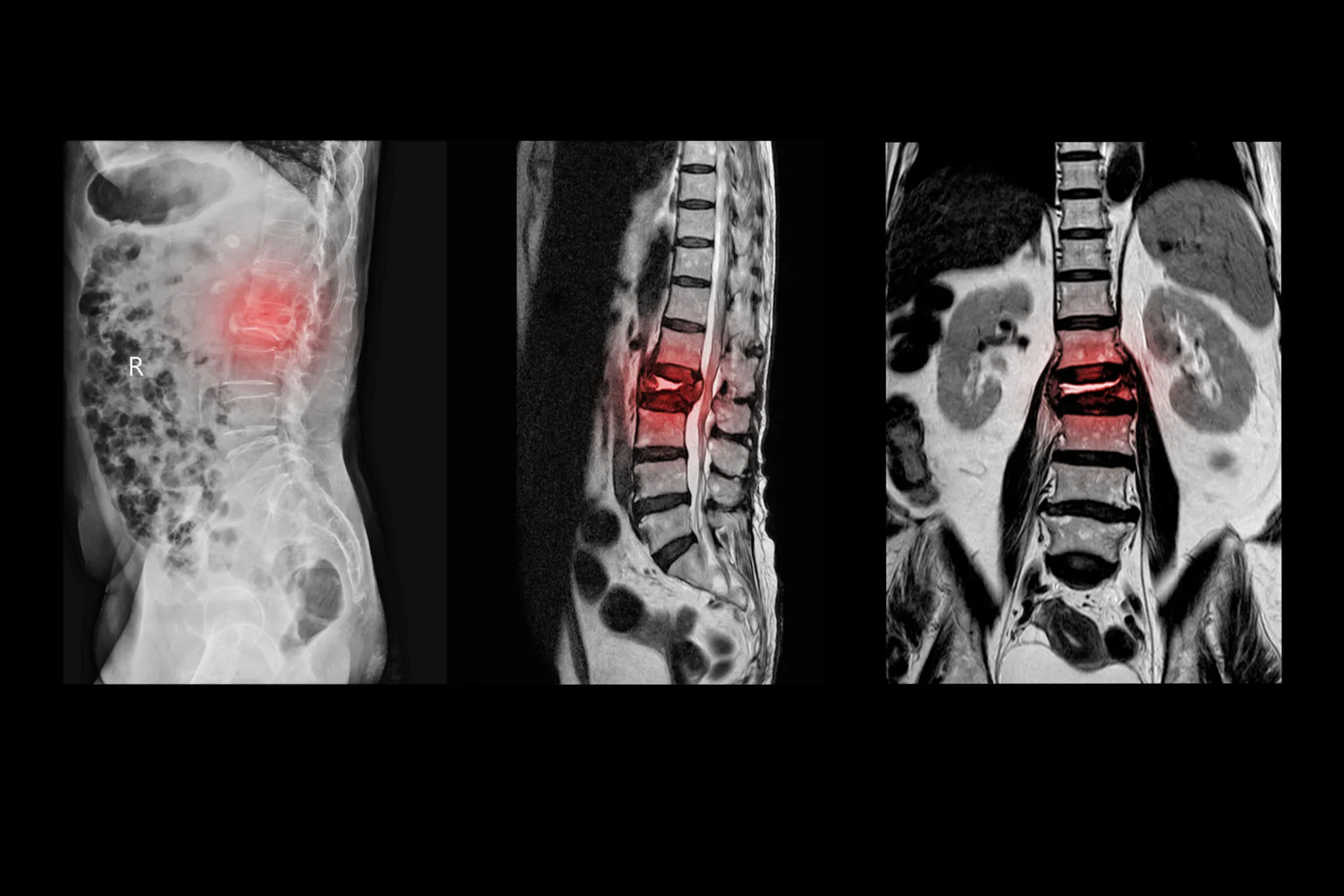 The-Multilevel-Degenerative-Disc-Disease-Is-the-no-1-Cause-of-Back-Pain